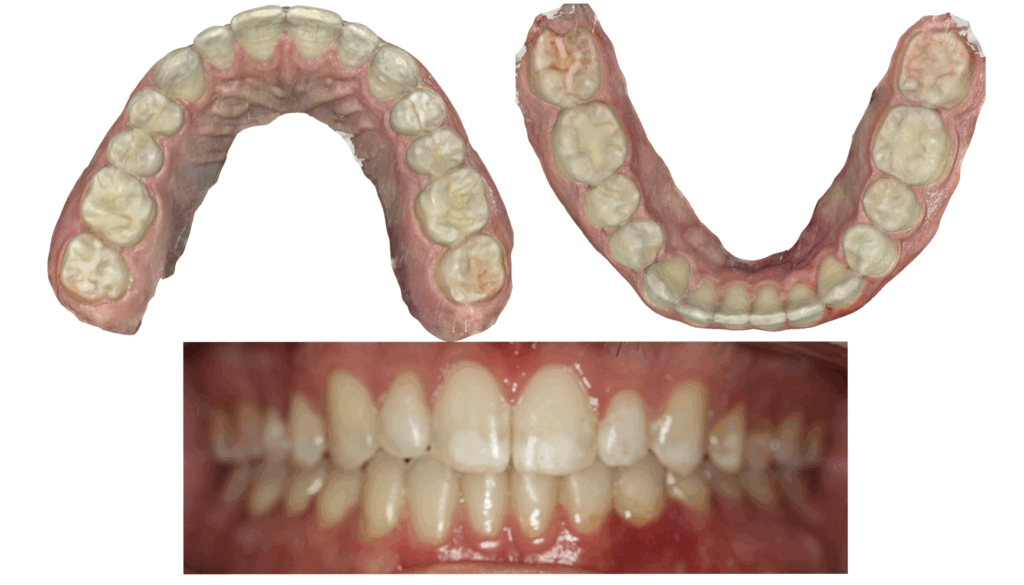 Permanent Retainers