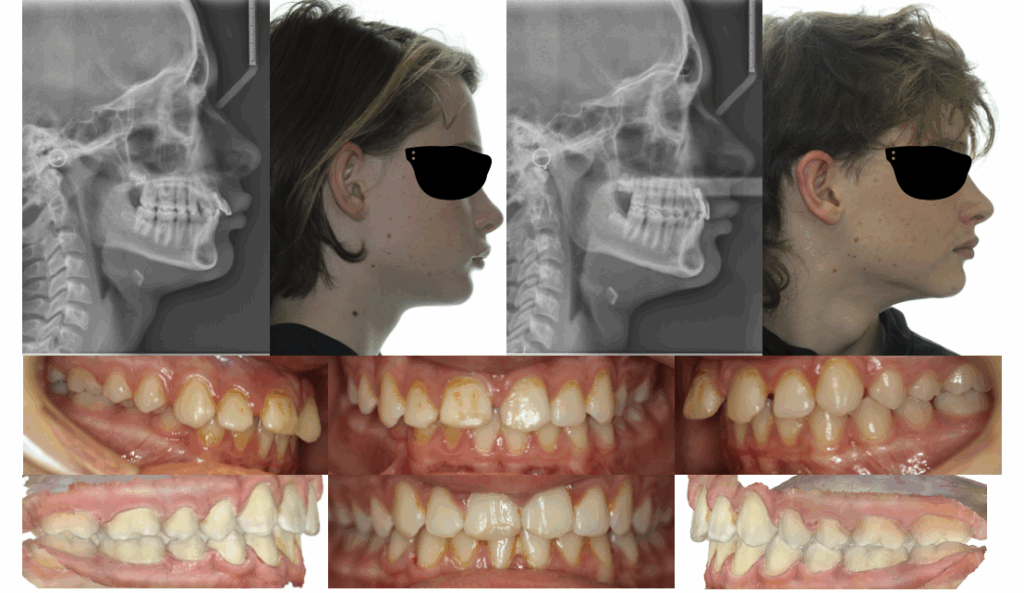 Traumatized Anteriors & Overjet