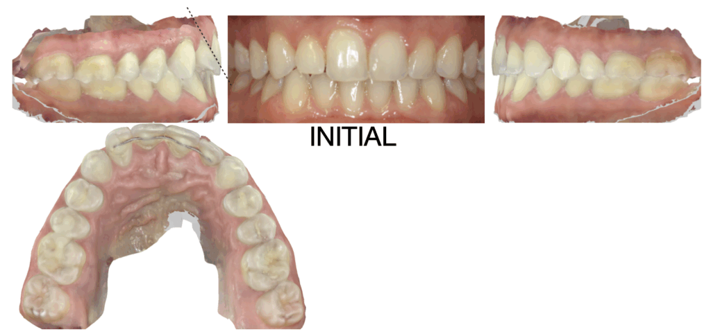 Invisalign can’t Torque roots: Or can it?