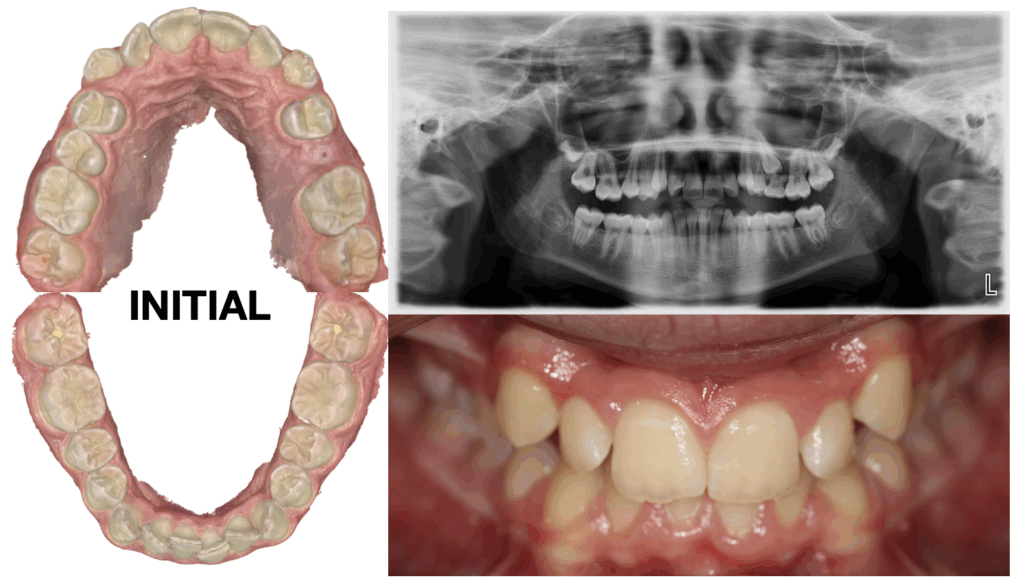 Canines And A Deep Bite