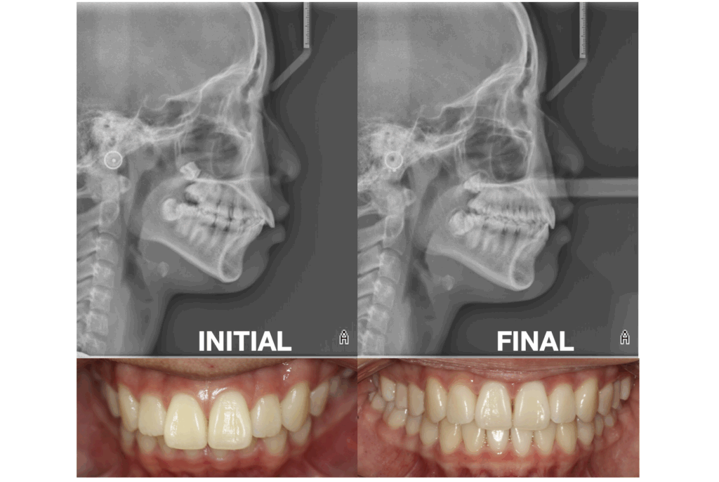improving protrusion & Profile: non-extraction with invisalign