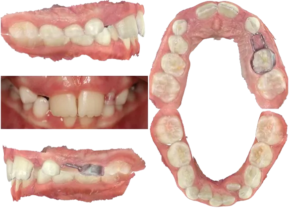 Phase I - Severe Crowding