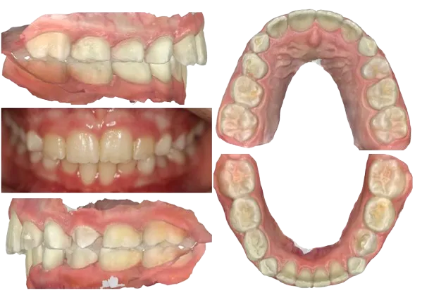 Phase I - Severe Crowding